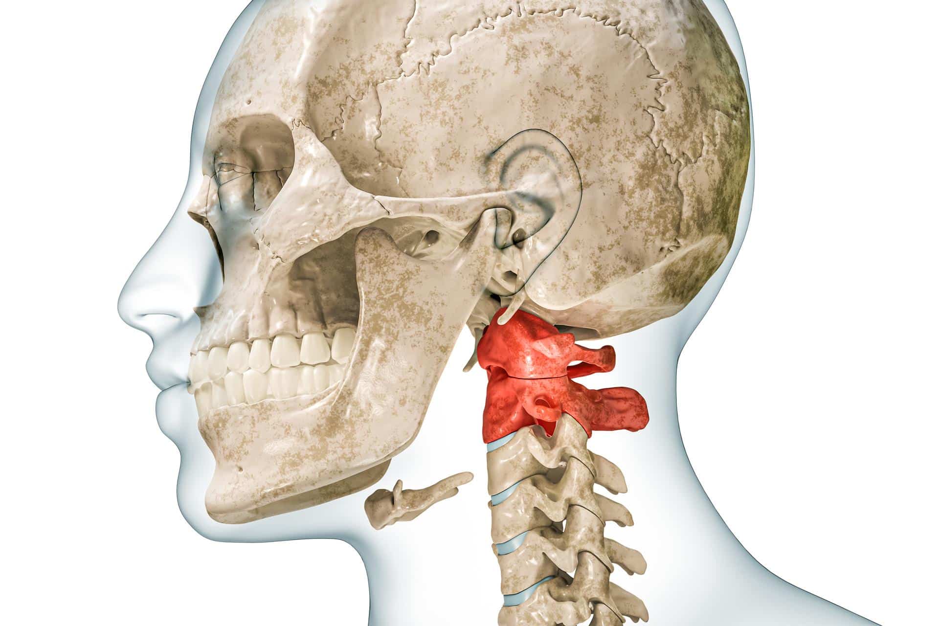 Anatomical illustration highlighting atlantoaxial joint dysfunction in the upper cervical spine, showing misalignment at C1-C2 vertebrae