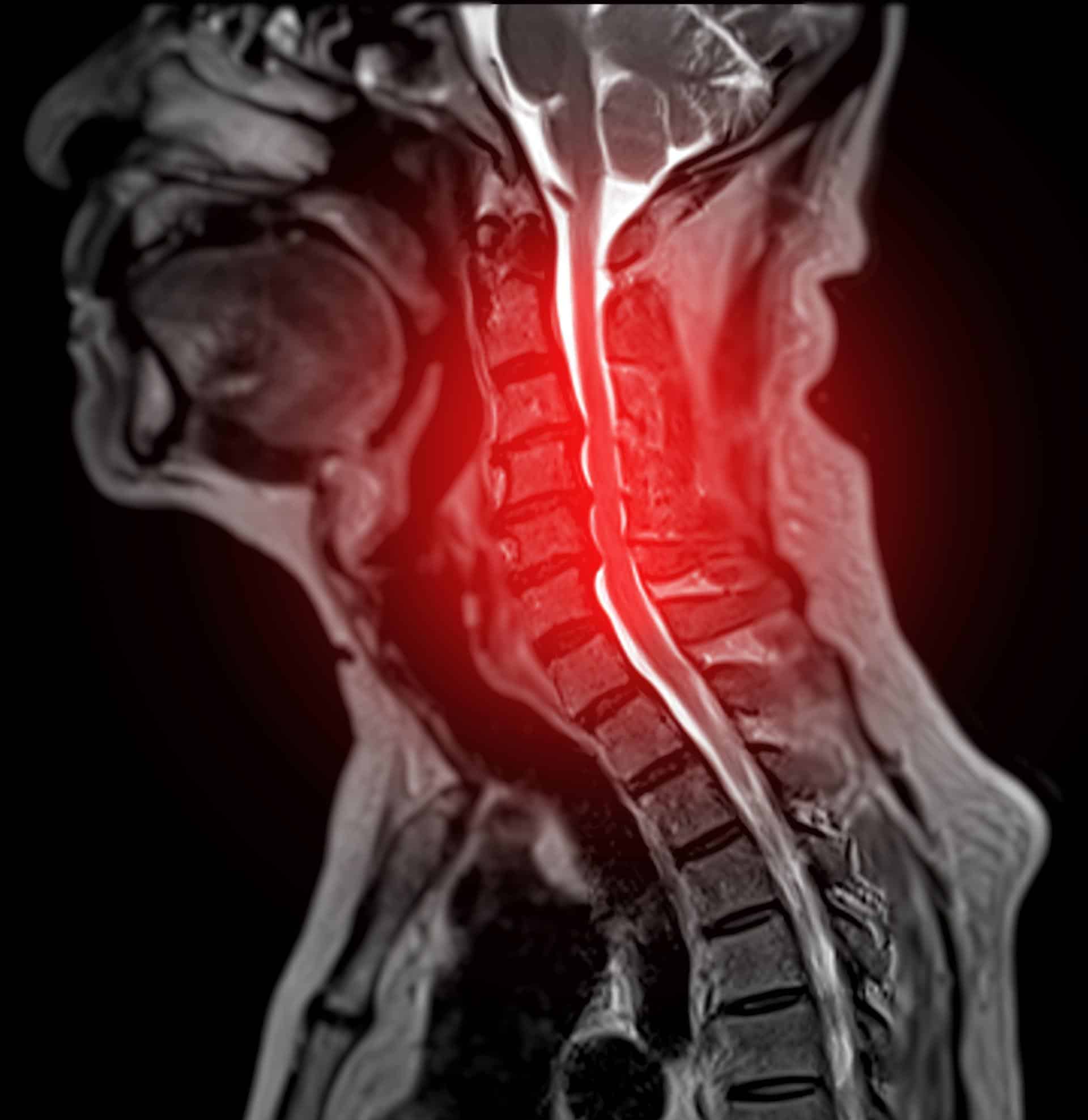 MRI of the cervical spine showing disc herniation and radiculopathy in a Lafayette, LA patient