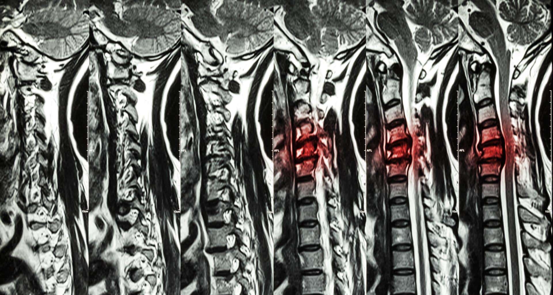 MRI scan showing cervical joint hypermobility and spinal instability in a patient from Lafayette, Louisiana.