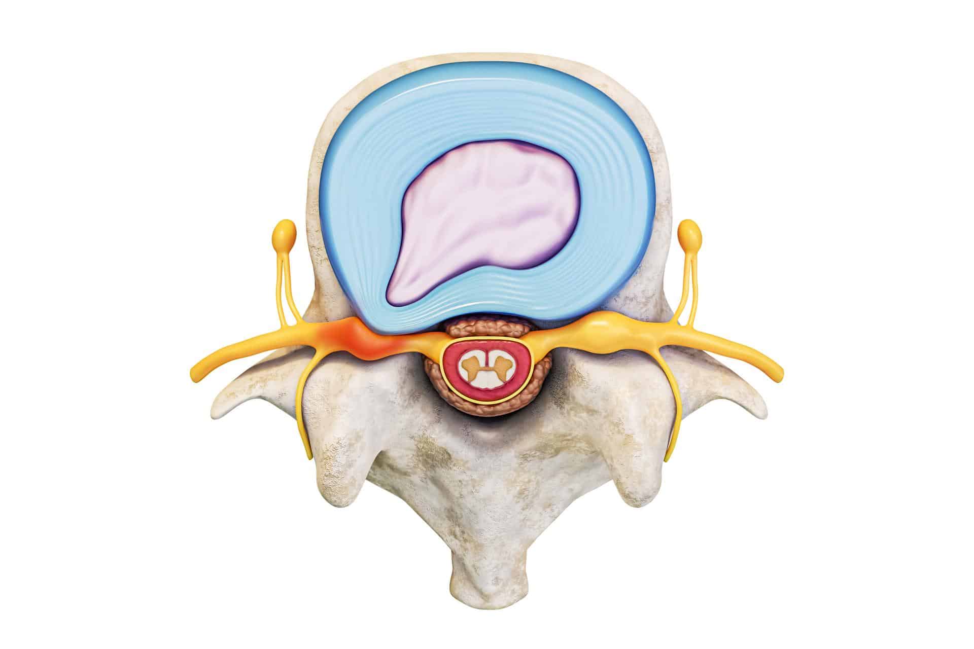 Illustration of spinal disc displacement without myelopathy showing nerve root compression, used by Cavanaugh Chiropractic in Lafayette, LA