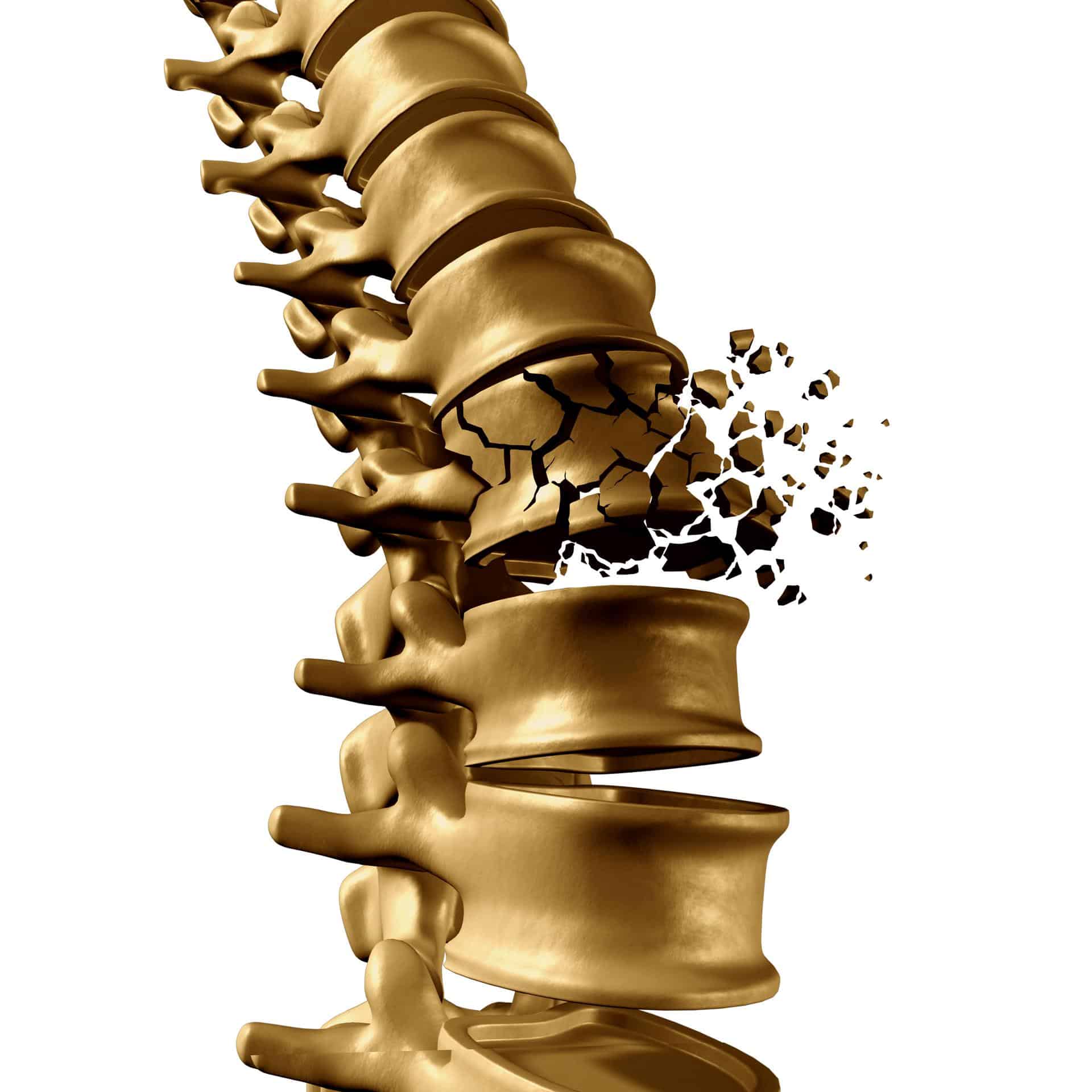 Illustration of a fractured lumbar vertebra symbolizing spinal damage and lower back pain