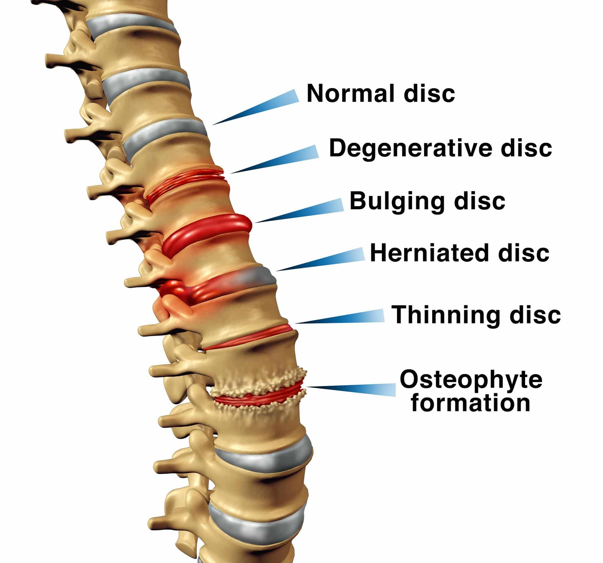Labeled lumbar spine illustration showing disc degeneration, herniation, and osteophyte formation.