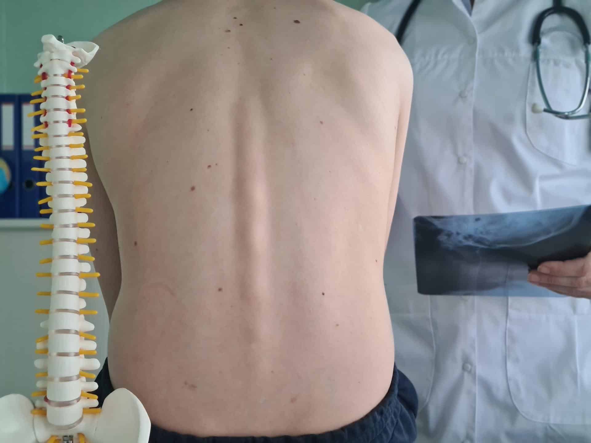 Thoracic Sprain